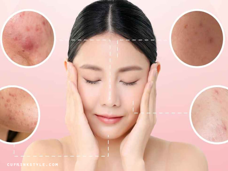 วิธีลดสิวให้หายเร็ว